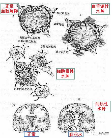 和“水”相关的几个概念:自由水和结合水、脑水肿 和“水”相关的几个概念:自由水和结合水、脑水肿