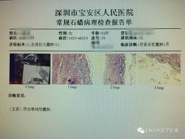 手把手教你会读片——囊性肾癌 手把手教你会读片——囊性肾癌