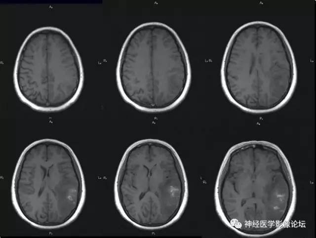 【病例】脑脱髓鞘假瘤1例MR影像讨论
