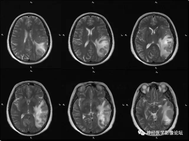 【病例】脑脱髓鞘假瘤1例MR影像讨论