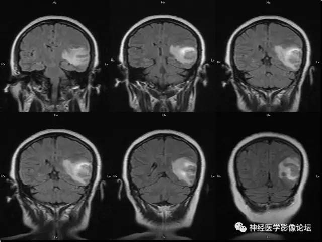 【病例】脑脱髓鞘假瘤1例MR影像讨论