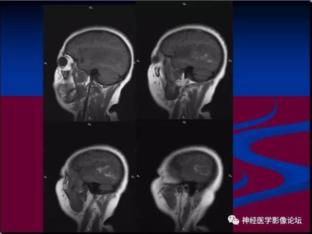 【病例】脑脱髓鞘假瘤1例MR影像讨论