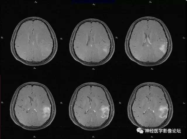 【病例】脑脱髓鞘假瘤1例MR影像讨论