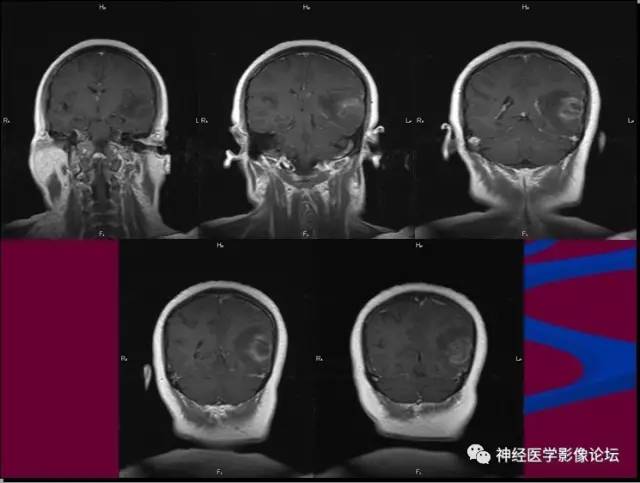 【病例】脑脱髓鞘假瘤1例MR影像讨论