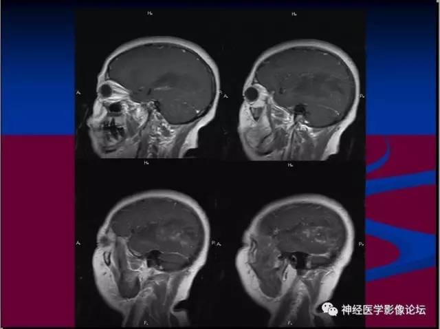 【病例】脑脱髓鞘假瘤1例MR影像讨论