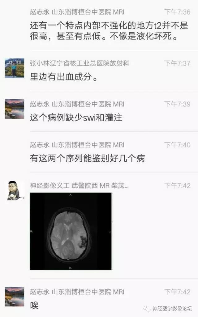 【病例】脑脱髓鞘假瘤1例MR影像讨论