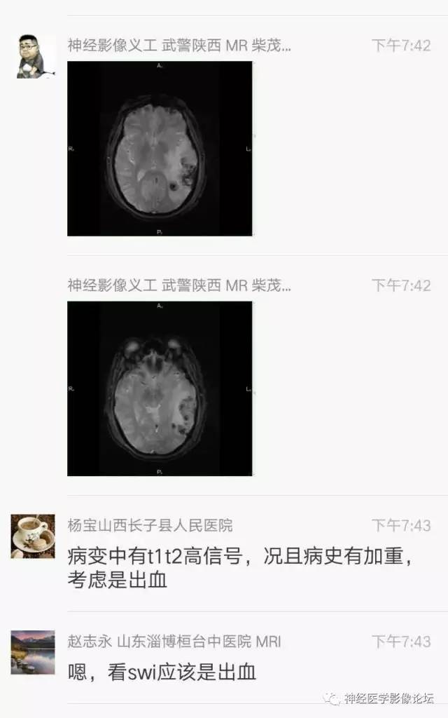 【病例】脑脱髓鞘假瘤1例MR影像讨论