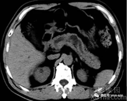 【病例】慢性胰腺炎1例CT影像表现 【病例】慢性胰腺炎1例CT影像表现