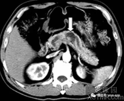 【病例】慢性胰腺炎1例CT影像表现 【病例】慢性胰腺炎1例CT影像表现