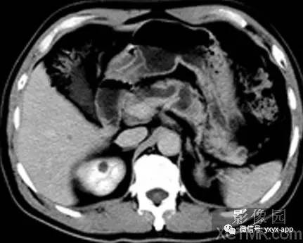 【病例】慢性胰腺炎1例CT影像表现
