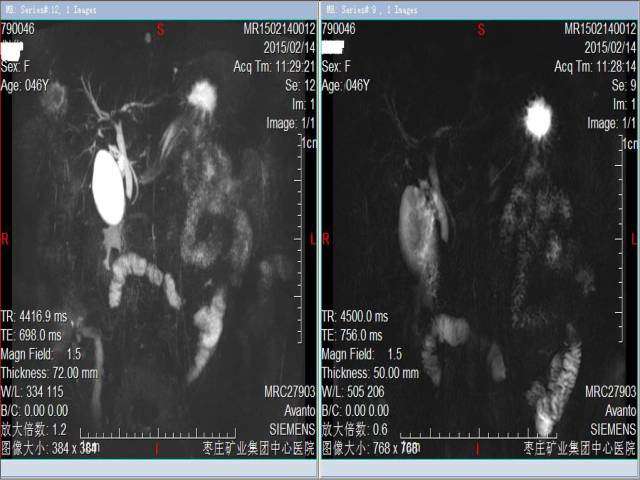 【病例】肝脏神经内分泌癌伴肝内多发转移1例MR 【病例】肝脏神经内分泌癌伴肝内多发转移1例MR
