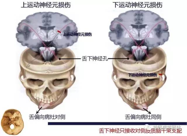 【PPT】舌下神经解剖、影像及临床 【PPT】舌下神经解剖、影像及临床