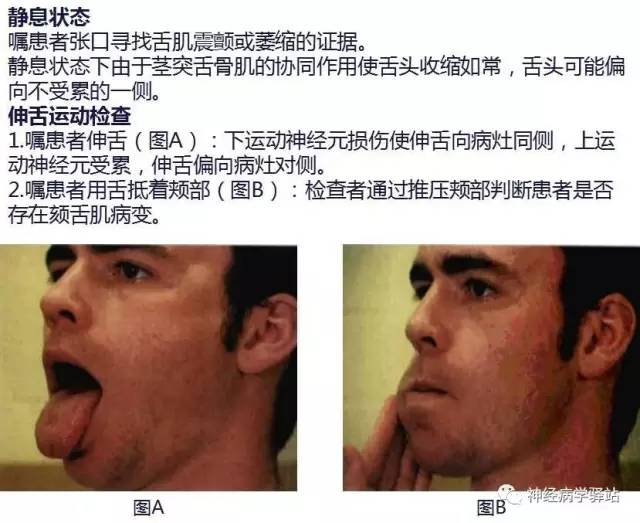 【PPT】舌下神经解剖、影像及临床 【PPT】舌下神经解剖、影像及临床