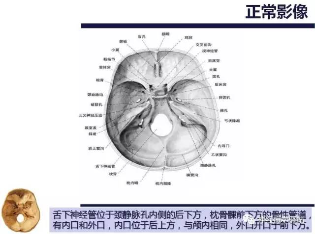 【PPT】舌下神经解剖、影像及临床 【PPT】舌下神经解剖、影像及临床