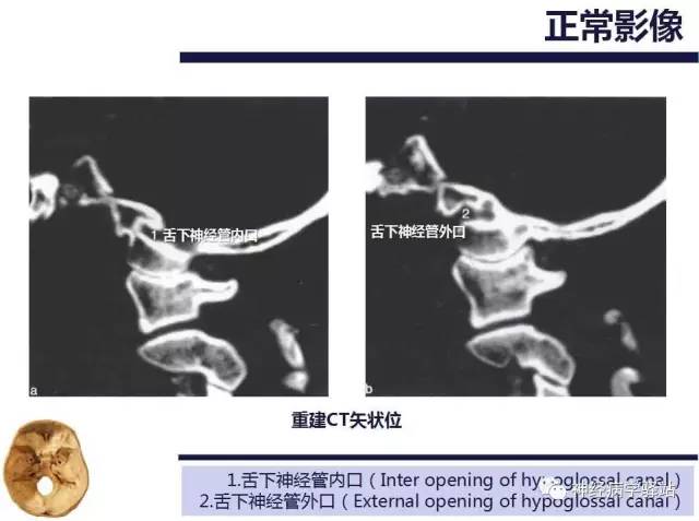 【PPT】舌下神经解剖、影像及临床 【PPT】舌下神经解剖、影像及临床