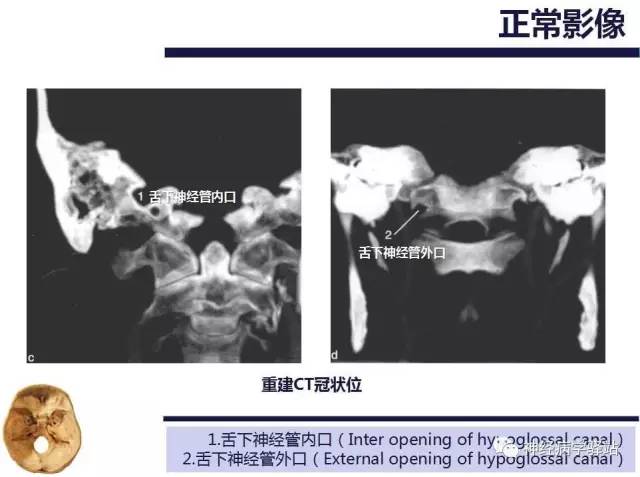 【PPT】舌下神经解剖、影像及临床 【PPT】舌下神经解剖、影像及临床