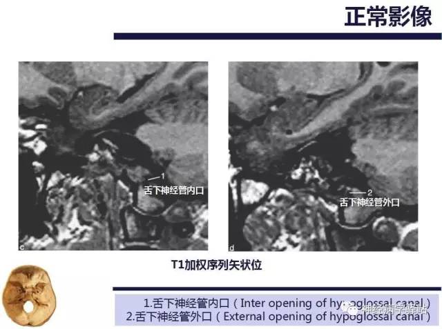【PPT】舌下神经解剖、影像及临床 【PPT】舌下神经解剖、影像及临床