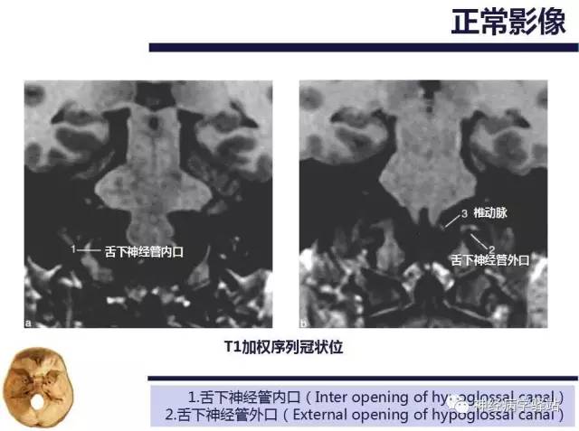 【PPT】舌下神经解剖、影像及临床 【PPT】舌下神经解剖、影像及临床