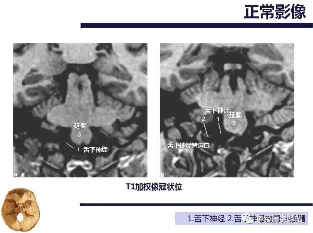【PPT】舌下神经解剖、影像及临床 【PPT】舌下神经解剖、影像及临床