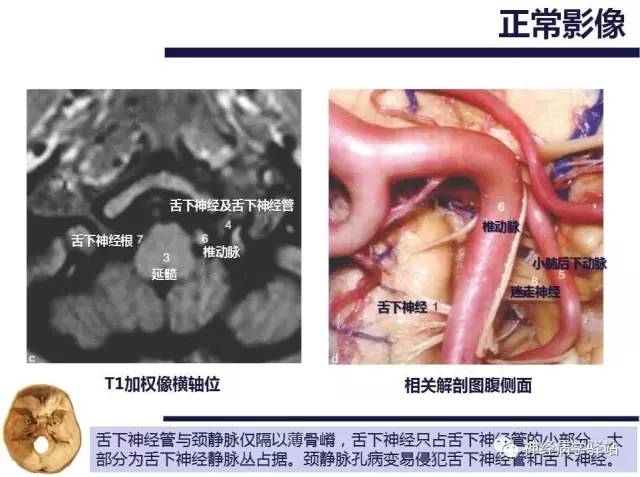 【PPT】舌下神经解剖、影像及临床 【PPT】舌下神经解剖、影像及临床