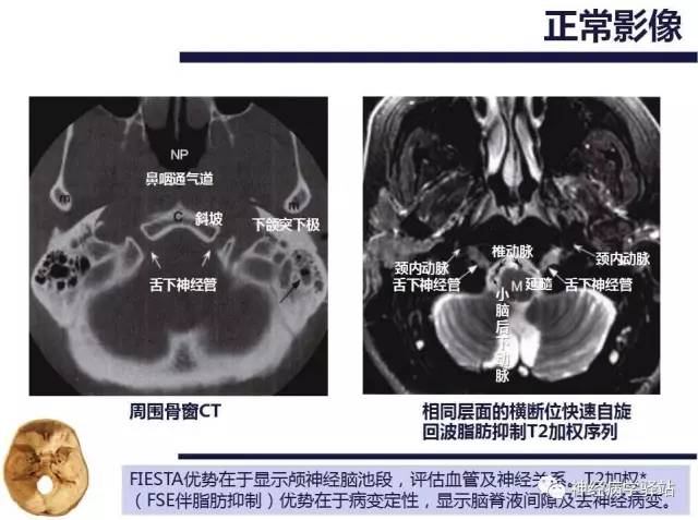 【PPT】舌下神经解剖、影像及临床 【PPT】舌下神经解剖、影像及临床