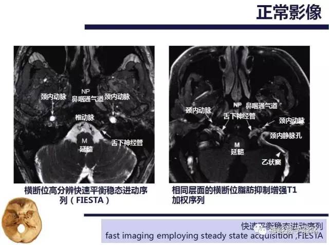 【PPT】舌下神经解剖、影像及临床 【PPT】舌下神经解剖、影像及临床
