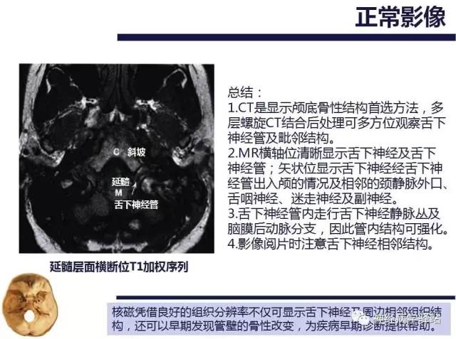 【PPT】舌下神经解剖、影像及临床 【PPT】舌下神经解剖、影像及临床