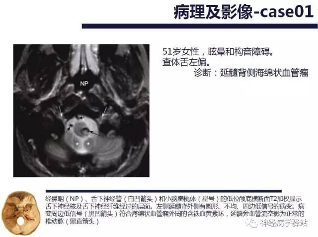 【PPT】舌下神经解剖、影像及临床 【PPT】舌下神经解剖、影像及临床