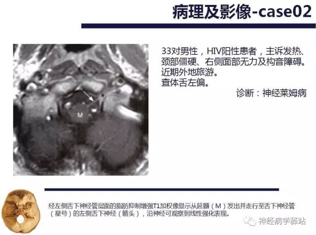 【PPT】舌下神经解剖、影像及临床 【PPT】舌下神经解剖、影像及临床