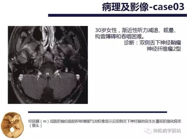 【PPT】舌下神经解剖、影像及临床 【PPT】舌下神经解剖、影像及临床