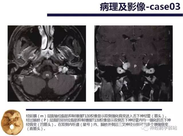 【PPT】舌下神经解剖、影像及临床 【PPT】舌下神经解剖、影像及临床