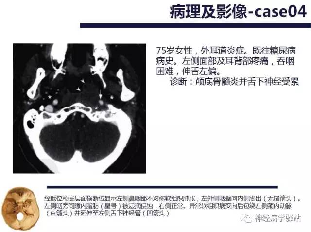 【PPT】舌下神经解剖、影像及临床 【PPT】舌下神经解剖、影像及临床