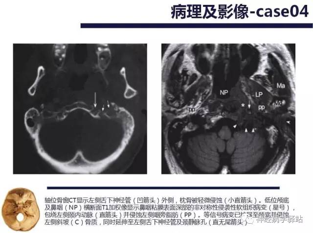 【PPT】舌下神经解剖、影像及临床 【PPT】舌下神经解剖、影像及临床