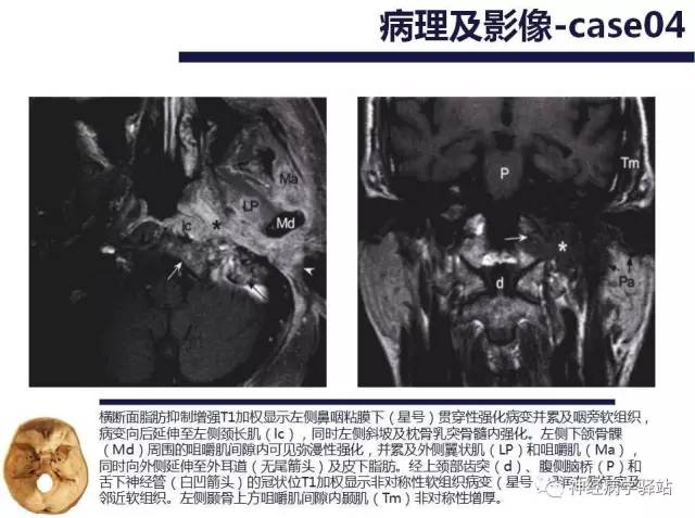 【PPT】舌下神经解剖、影像及临床 【PPT】舌下神经解剖、影像及临床