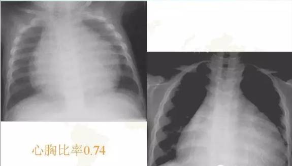 胸部影像学征象——
