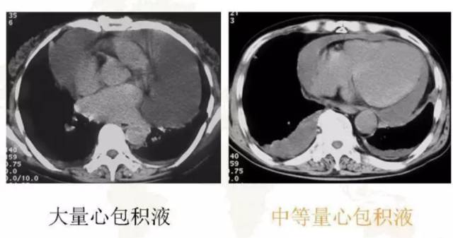 胸部影像学征象——