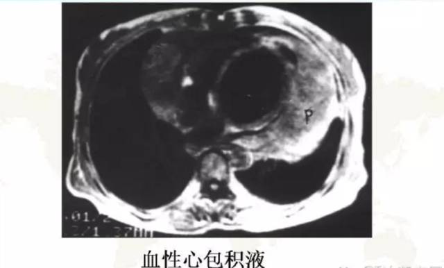 胸部影像学征象——
