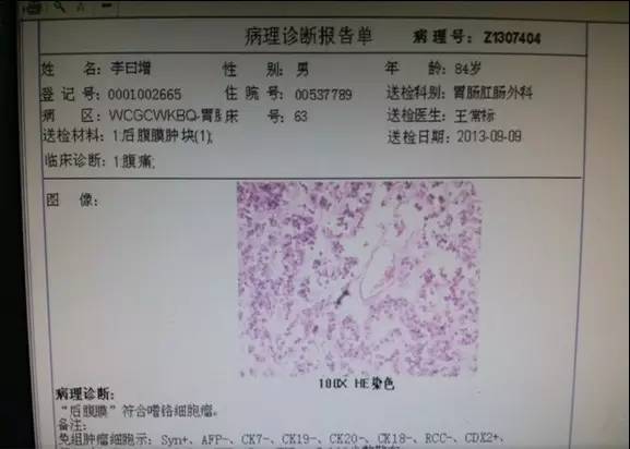 【病例】腹膜后异位嗜铬细胞瘤1例CT