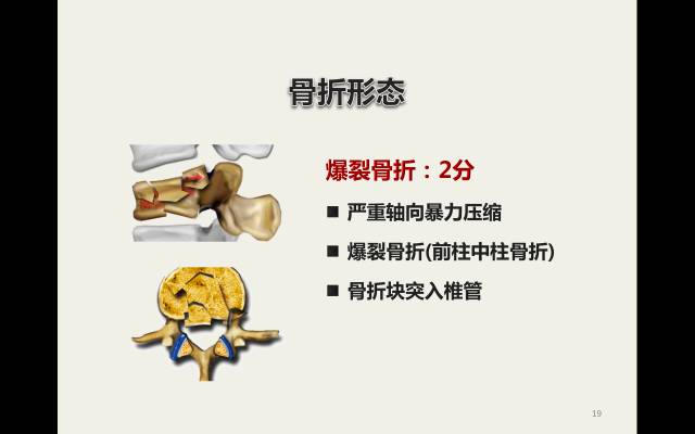 【病例】胸腰椎损伤分型及严重程度评分(TLICS)：影像与临床