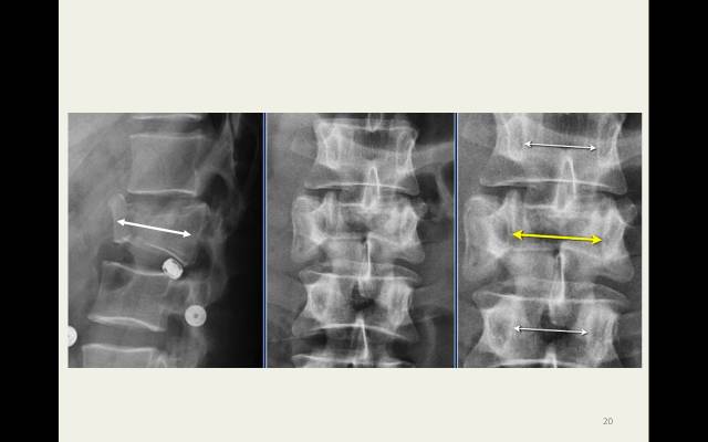 【病例】胸腰椎损伤分型及严重程度评分(TLICS)：影像与临床