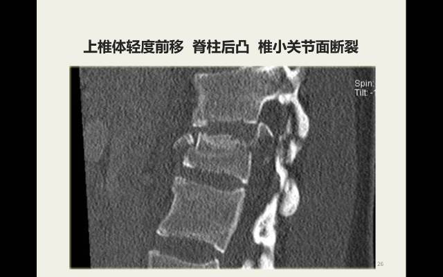【病例】胸腰椎损伤分型及严重程度评分(TLICS)：影像与临床