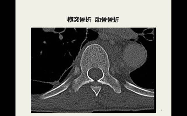 【病例】胸腰椎损伤分型及严重程度评分(TLICS)：影像与临床