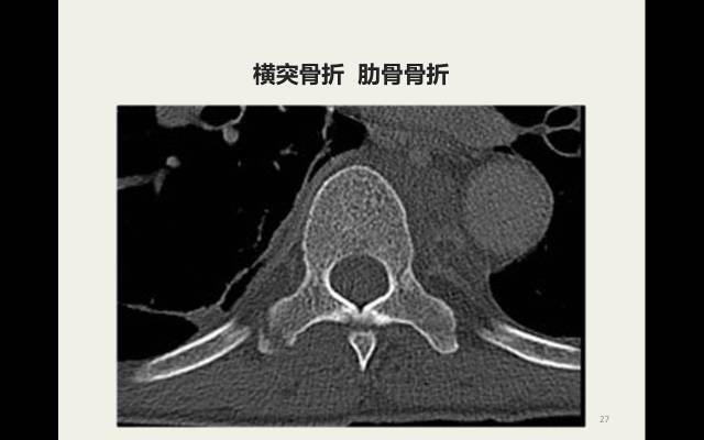 【病例】胸腰椎损伤分型及严重程度评分(TLICS)：影像与临床