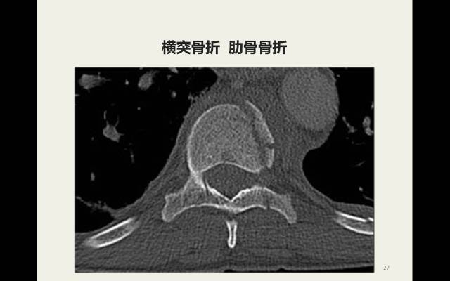【病例】胸腰椎损伤分型及严重程度评分(TLICS)：影像与临床