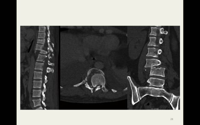 【病例】胸腰椎损伤分型及严重程度评分(TLICS)：影像与临床