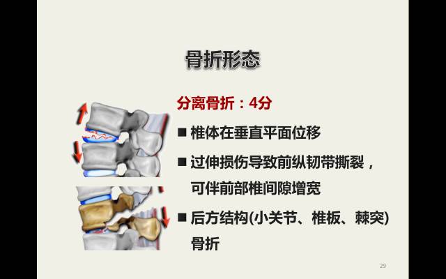 【病例】胸腰椎损伤分型及严重程度评分(TLICS)：影像与临床