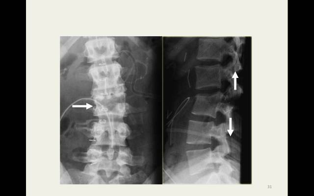 【病例】胸腰椎损伤分型及严重程度评分(TLICS)：影像与临床