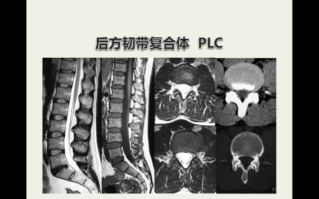 【病例】胸腰椎损伤分型及严重程度评分(TLICS)：影像与临床