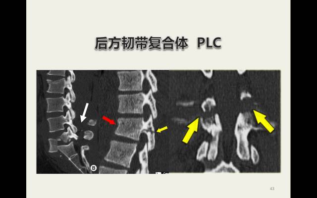 【病例】胸腰椎损伤分型及严重程度评分(TLICS)：影像与临床