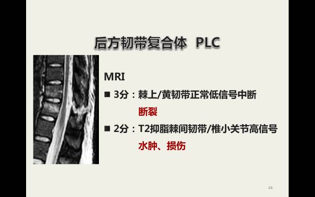 【病例】胸腰椎损伤分型及严重程度评分(TLICS)：影像与临床